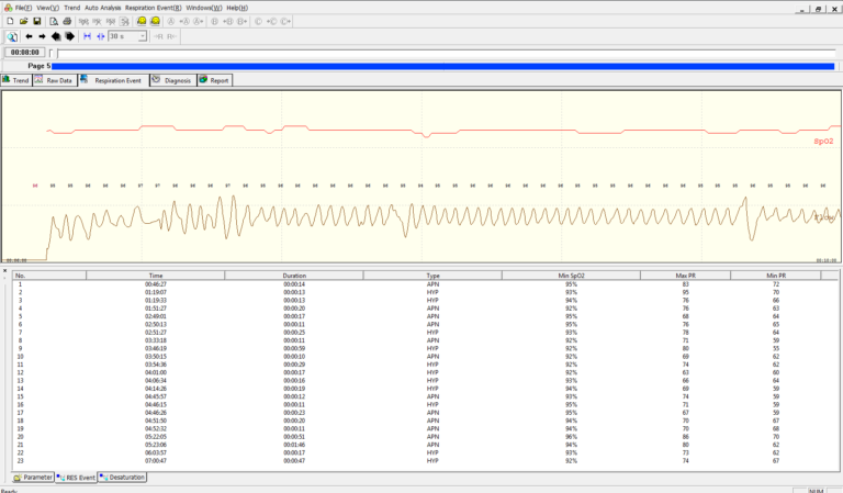 υπνική άπνοια Κατσούλας katsoulas.eu